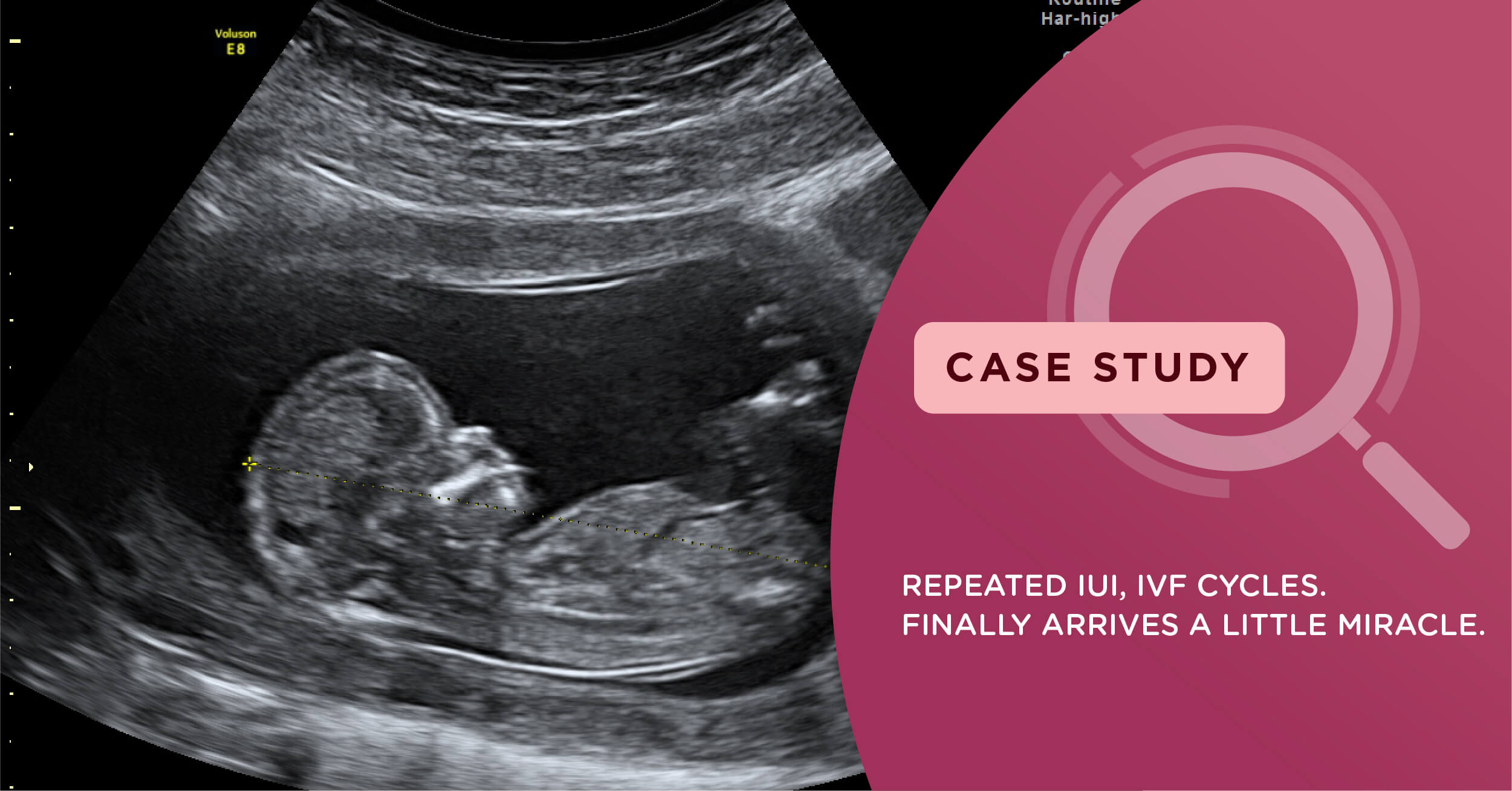 5 IUI Cycles, 5 Miscarriages, 2 Failed IVF Cycles and Finally 1 Little Miracle