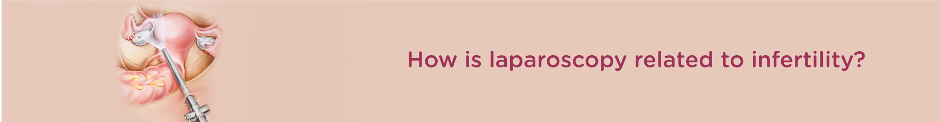 How is Laparoscopy related to infertility?