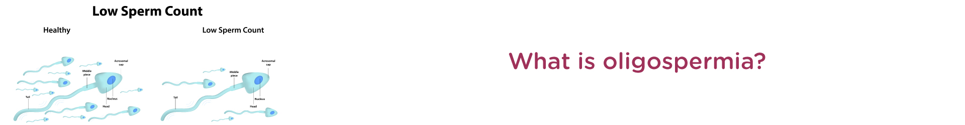 How is Oligospermia Treated?
