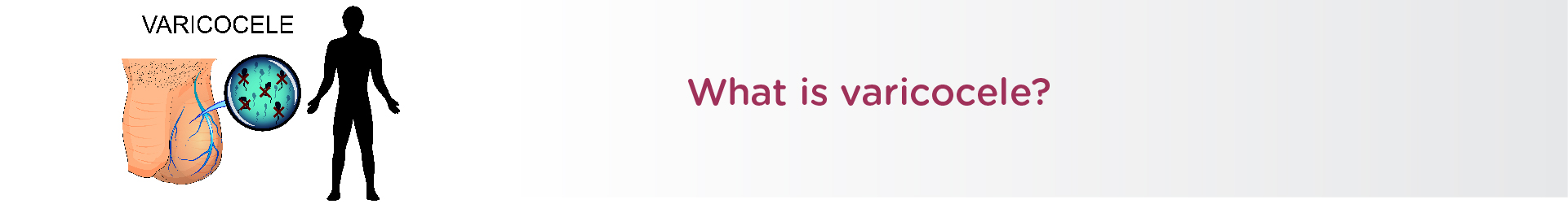 What is varicocele?