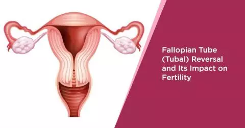 Fallopian Tube (Tubal) Reversal and Its Impact on Fertility