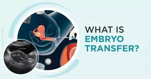 embryo transfer