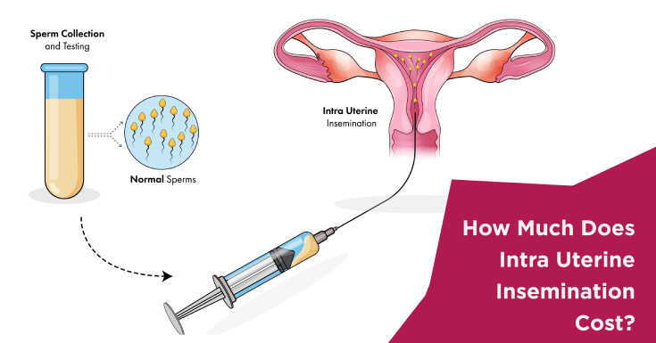 How Much Does Intra Uterine Insemination Cost?