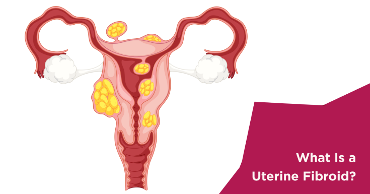 What Is a Uterine Fibroid?