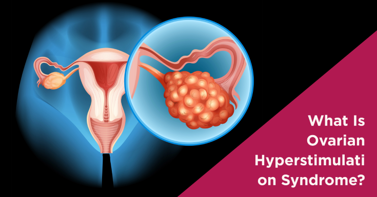 What Is Ovarian Hyperstimulation Syndrome?