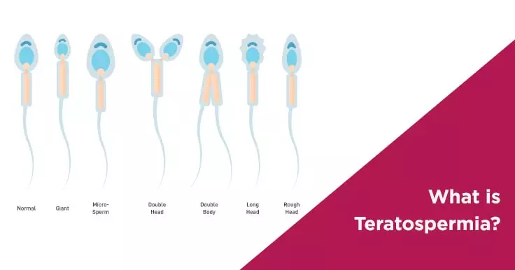 What is Teratospermia?