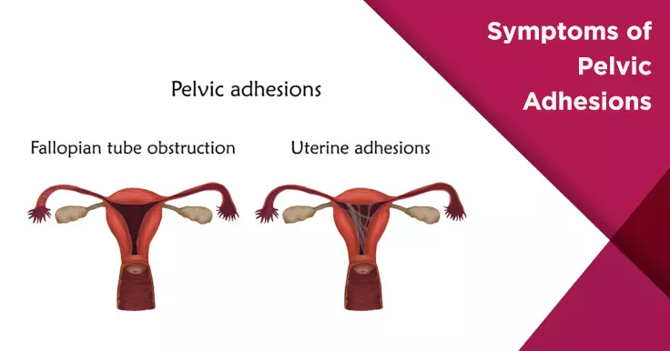 Symptoms of Pelvic Adhesions