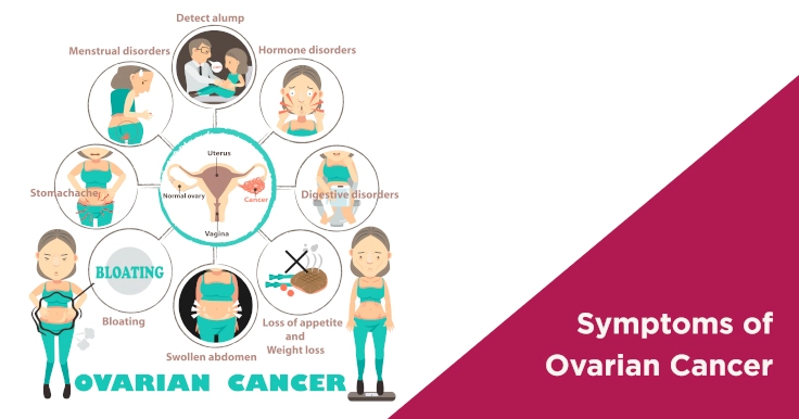 Ovarian Cancer Symptoms: What Woman Need to Know |Nova IVF