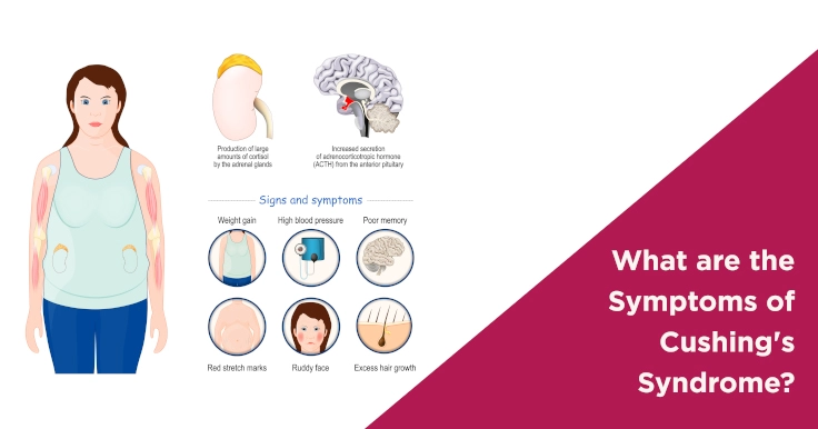 What are the Symptoms of Cushing's Syndrome?