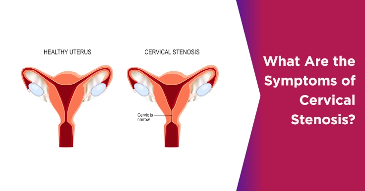 Cervical Stenosis - Women's Health Issues - Merck Manuals Consumer