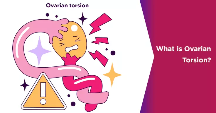 What is Ovarian Torsion?