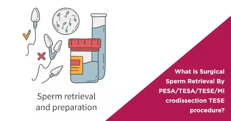 What is Surgical Sperm Retrieval By PESA/TESA/TESE/Microdissection TESE procedure?
