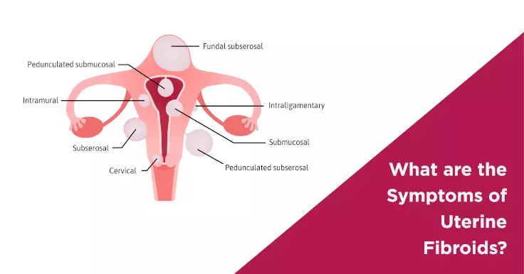 What are the Symptoms of Uterine Fibroids?