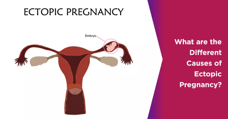 What are the Different Causes of Ectopic Pregnancy?