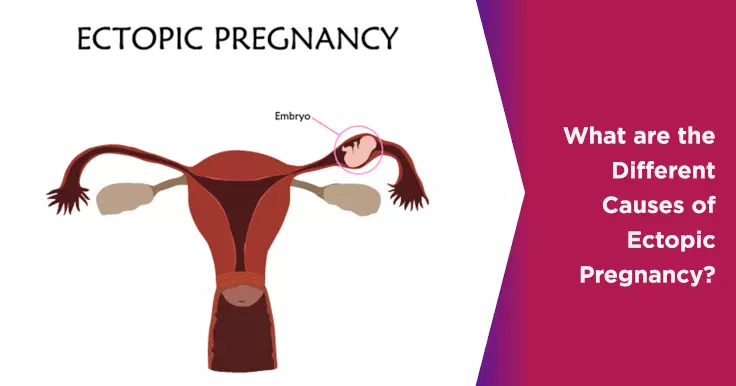 Ectopic Pregnancy: Causes, Symptoms & Treatments