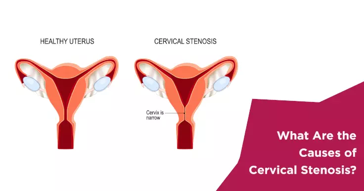 normal cervical os