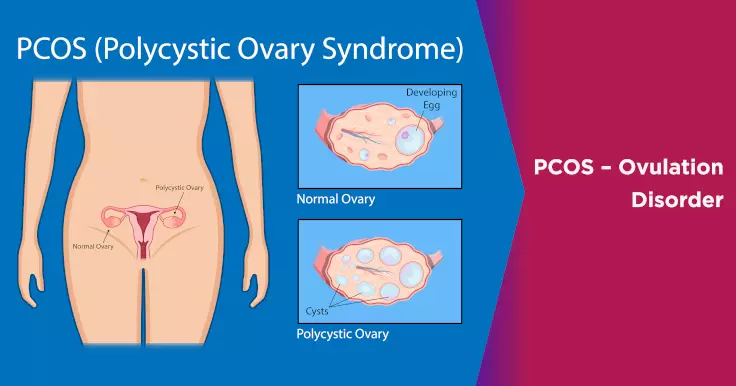 PCOS – Ovulation Disorder