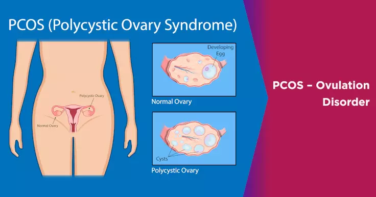 PCOS & Bloating: Why does it happen and how manage it - Fertility