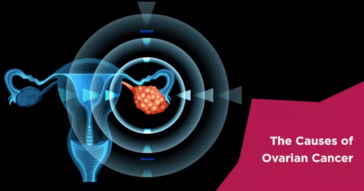 The Causes of Ovarian Cancer