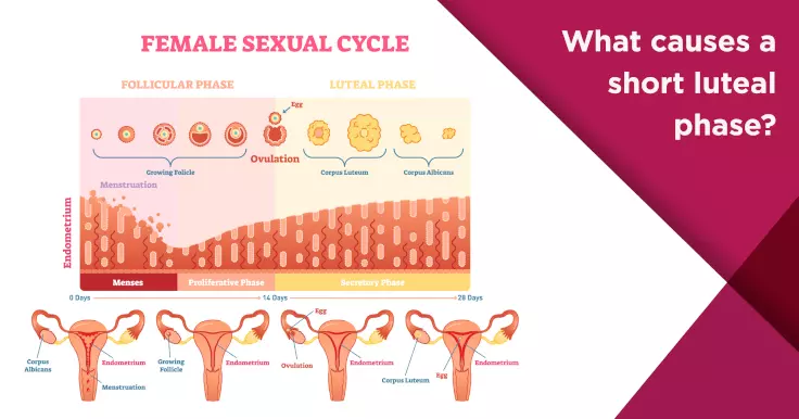 What causes a short luteal phase?