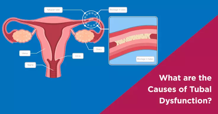 What are the Causes of Tubal Dysfunction?