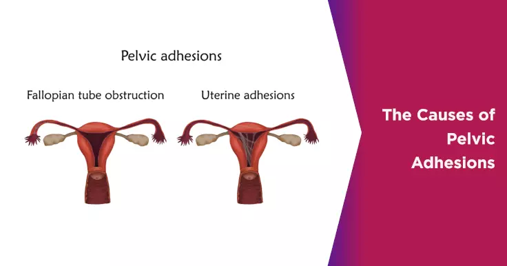 The Causes of Pelvic Adhesions