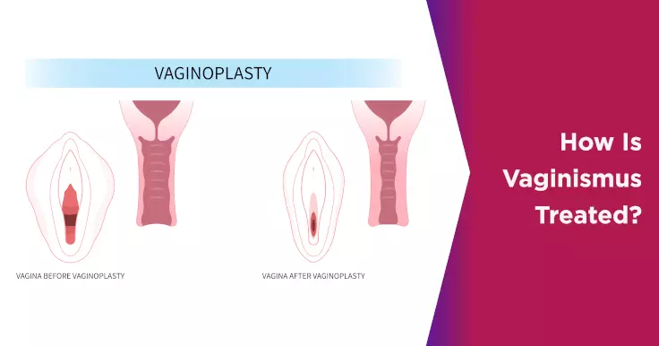 How Is Vaginismus Treated?