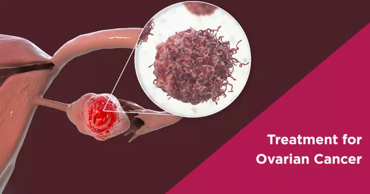 Treatment for Ovarian Cancer