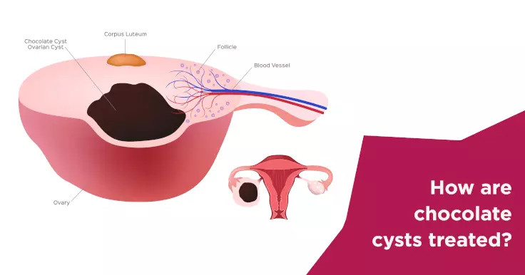 How are chocolate cysts treated?
