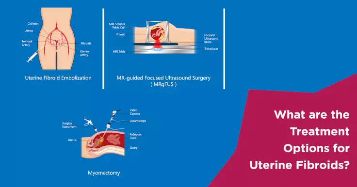 What are the Treatment Options for Uterine Fibroids?