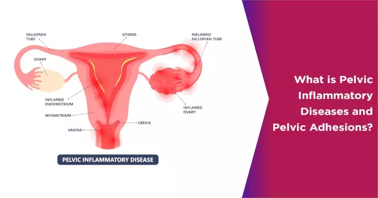What is Pelvic Inflammatory Diseases and Pelvic Adhesions?