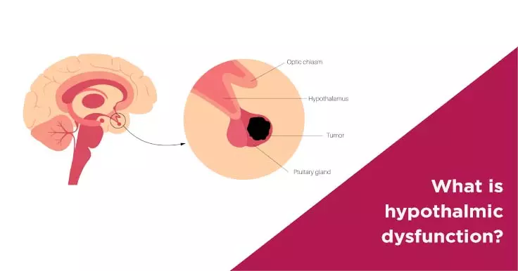 What is hypothalmic dysfunction?