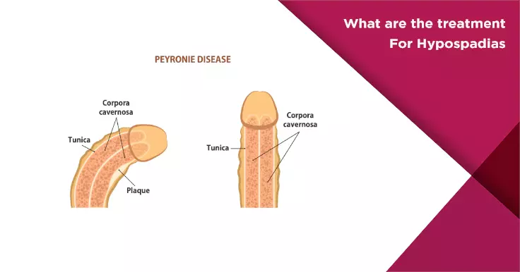 What are the treatment For Hypospadias