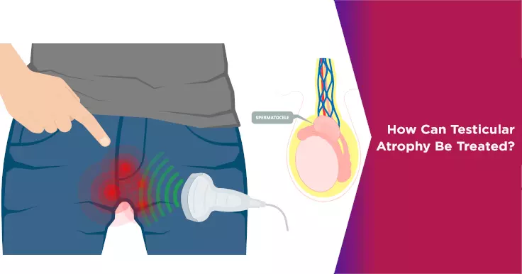 Spermatocele: Causes, Symptoms, Diagnosis & Treatment