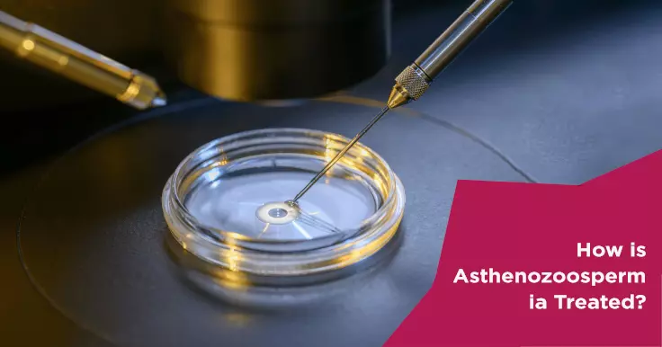 How is Asthenozoospermia Treated?