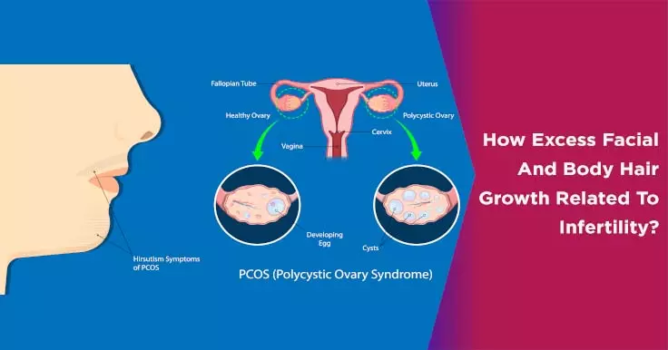 hirsutism pcos treatment