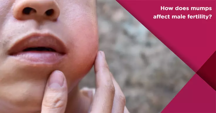 How does mumps affect male fertility?