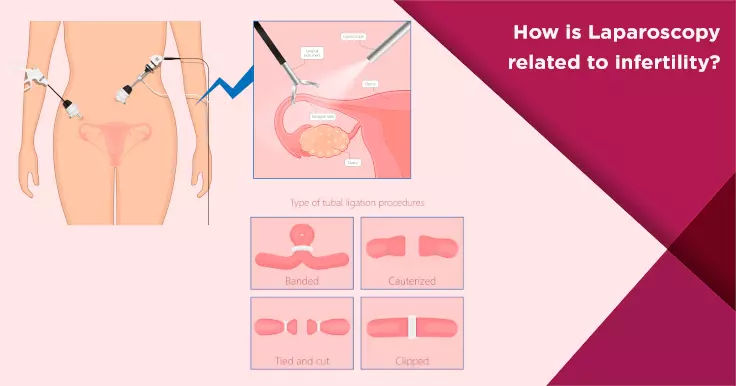 How is Laparoscopy related to infertility?