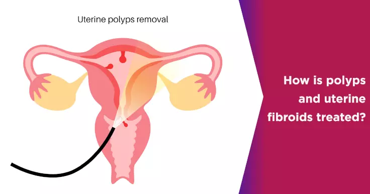 How is polyps and uterine fibroids treated?