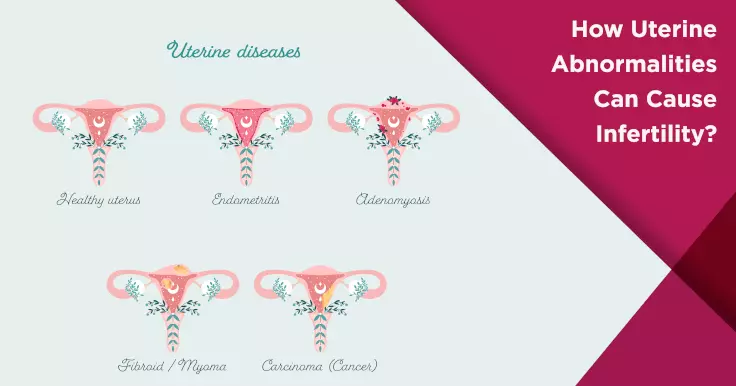 How Uterine Abnormalities Can Cause Infertility?