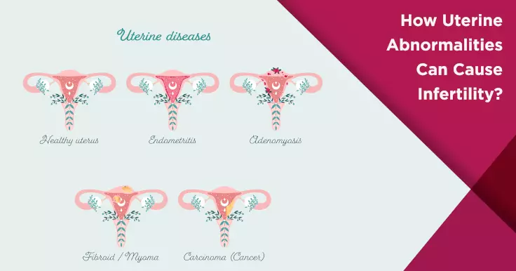 Understanding the Link: Uterine Abnormalities and Infertility