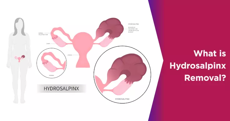 What is Hydrosalpinx Removal?