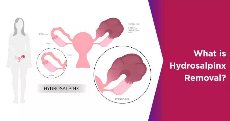 Prolactin and Infertility