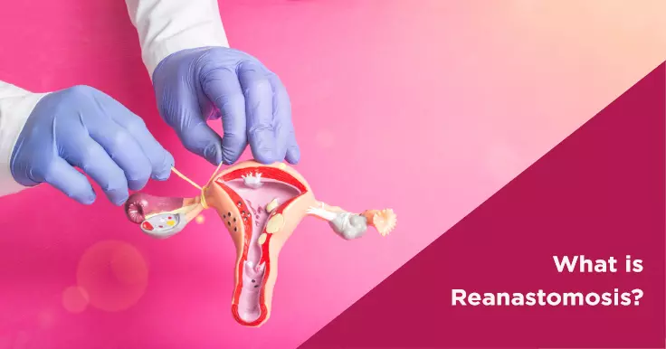 What is Reanastomosis?