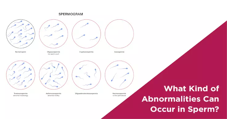 What Kind of Abnormalities Can Occur in Sperm?