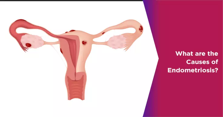 What are the Causes of Endometriosis?