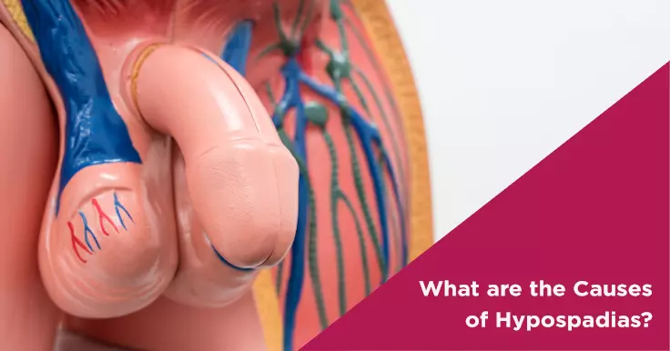 What are the Causes of Hypospadias?