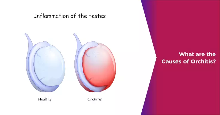  What are the Causes of Orchitis?