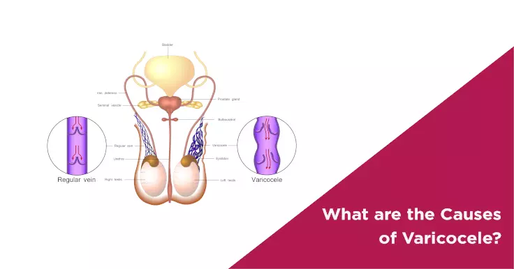 What are the Causes of Varicocele?