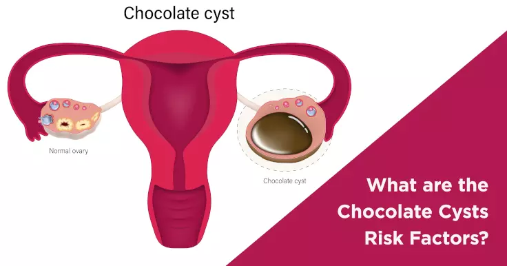 What are the Chocolate Cysts Risk Factors?